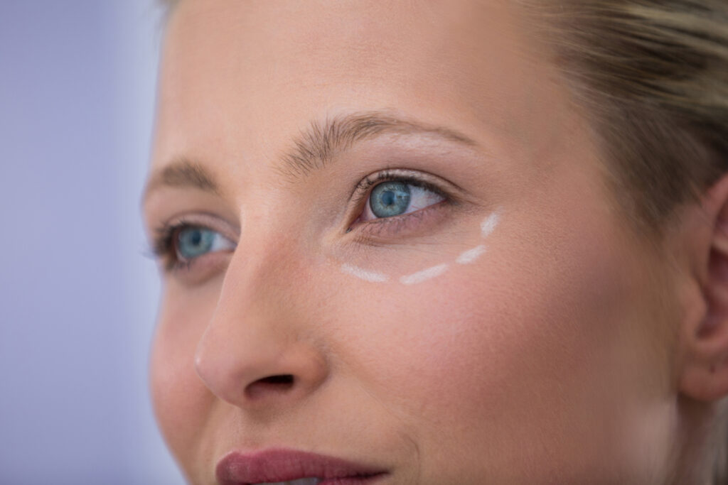 Close-up of woman with marks drawn for cosmetic treatment